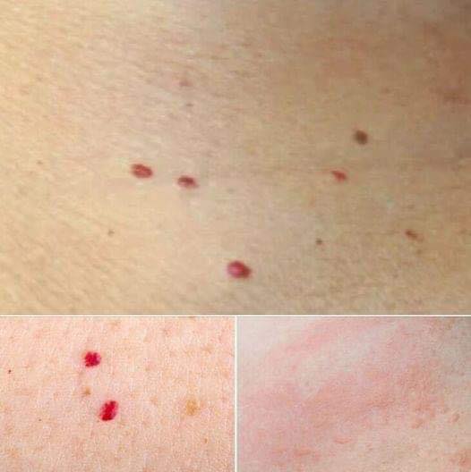 tiny pinpoint red spots on the skin